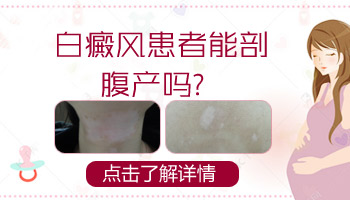 剖腹产白癜风会加重吗
