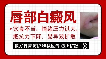 女性嘴角白癜风图片