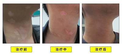 白癜风黑色素培植术后不照308可以吗