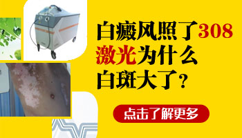 白癜风白斑照308后边缘变大怎么回事