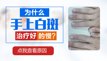 女孩手背白癜风三年了能治好吗 白斑怎么治