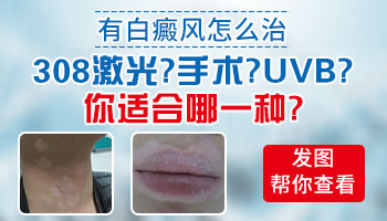 化工原料引起的白癜风怎么治