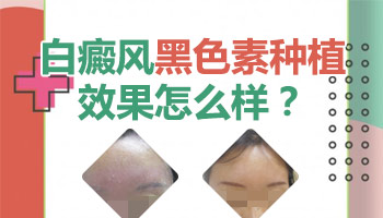 白癜风黑色素移植拆纱布后怎样的才算成功