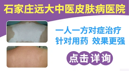 白癜风照窄谱UVB和308准分子光选哪个更合适