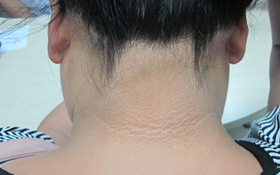 白癜风刚开始的症状图片