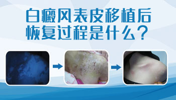 白癜风表皮移植后图片