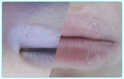 嘴角周围早期白癜风图片