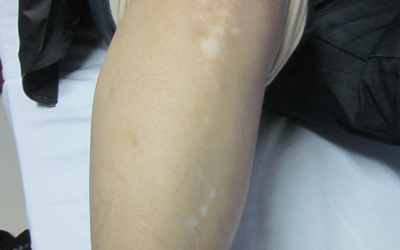 小孩腿上白斑ZUI初期的图片