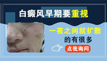 白癜风早期到白斑特别白需要多久