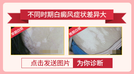 初期白癜风症状图片对比
