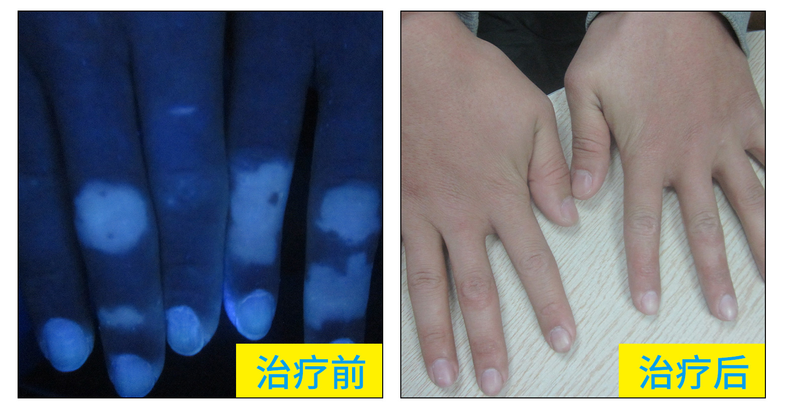 18岁高中生双手关节处白斑两年了近期有扩大了