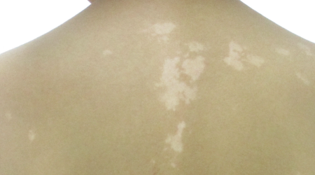 男人身上有白色的斑点是什么