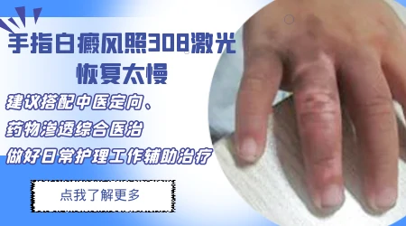 青少年手上白癜风照激光吃药能治好吗
