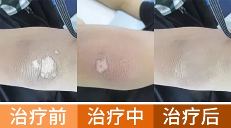 衡水哪里治疗白斑效果ZUI好