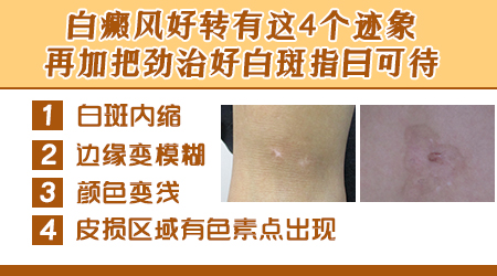 311照射白癜风好转现象