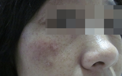 脸上豆粒大小的白斑是什么