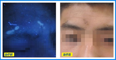 伍德灯下白癜风图片