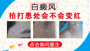 拍打揉搓按压等方法判断白斑是不是白癜风准确吗
