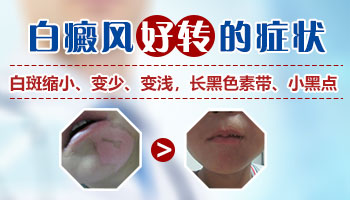 白癜风恢复好转的图片