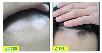 邯郸专门治白斑的医院