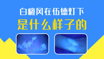 白癜风在伍德灯下和普通白斑在伍德灯下的区别