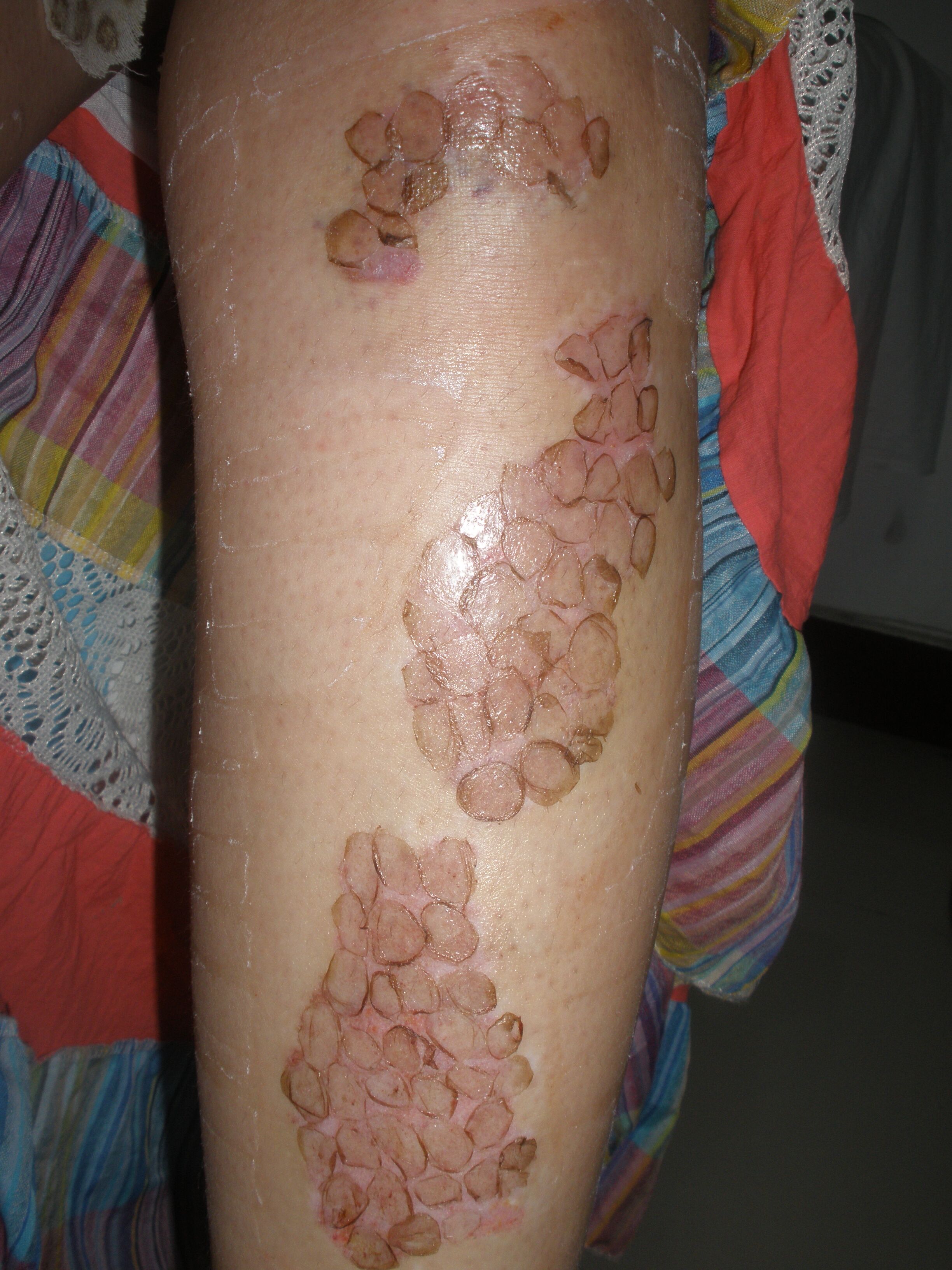 白癜风黑色素移植拆布的照片