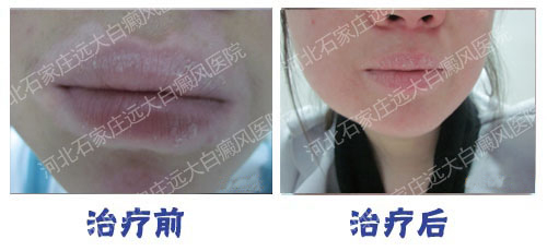 嘴皮上有白色的小点点是怎么回事