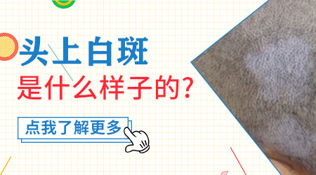 头上要是长了白斑如果是白癜风会是什么样子