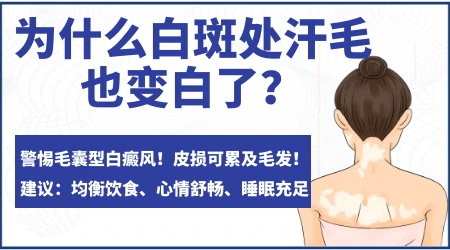 白癜风处汗毛变白了几根是不是说明病情加重