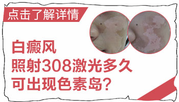 白癜风出现色素点是好转的征兆吗