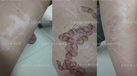 白癜风做完培植一周后是什么样子