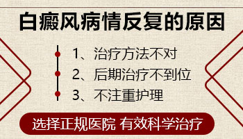 儿童白癜风治好是不是也一直会反反复复
