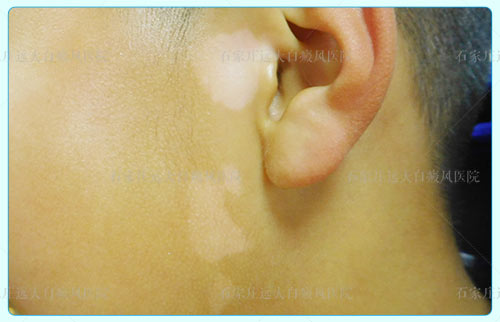 小孩面部白癜风早期图片