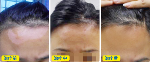 白斑周围有黑圈是什么