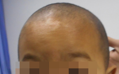 新生儿额头有几块白色的地方