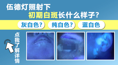 脚上有白斑怎么回事