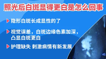 白癜风照uvb光后白斑更白了是什么情况