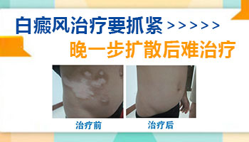 普通的白斑会自己消退吗