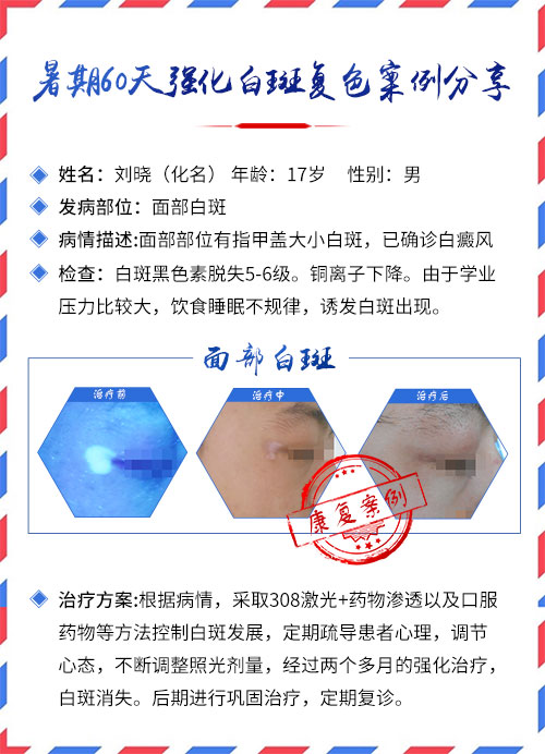 儿童手指白癜风能复色吗
