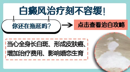 如果白癜风不治疗会有什么后果