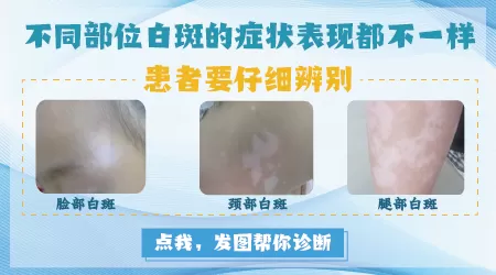 女性白斑早期症状