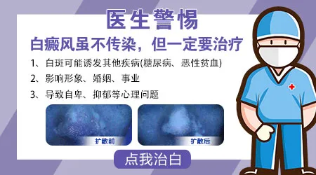 白癜风会不会传染给身边的家人