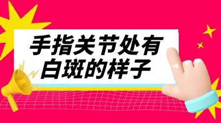 手指关节皮肤发白怎么回事 【关节白斑】
