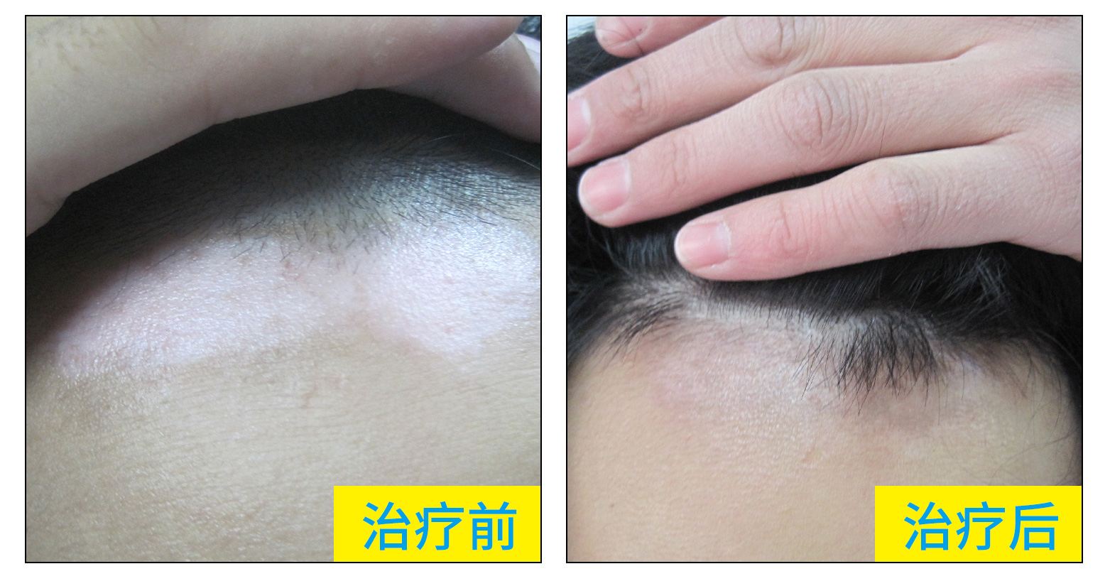 白癜风照一次308激光大概需要多少钱