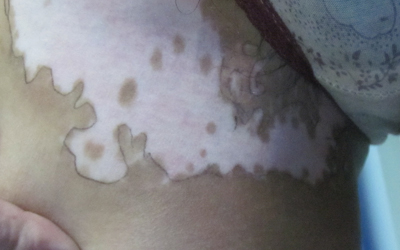 大腿内侧有一点点瓷白色斑点怎么回事