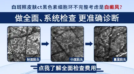伍德灯检查能确诊早期白癜风吗