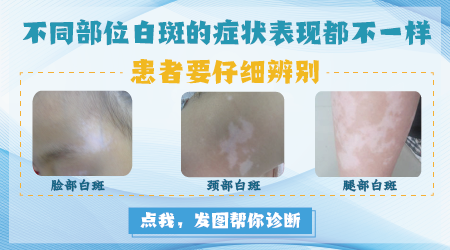 白斑是不是白癜风做哪些检查