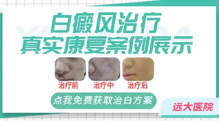 治身上白斑的方法 白癜风治疗案例