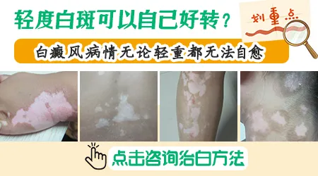 轻微的白癜风早期有没有可能自愈