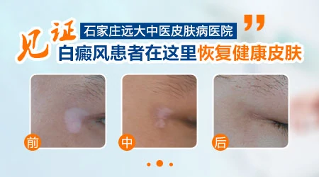 打完疫苗后身体出白斑怎么回事